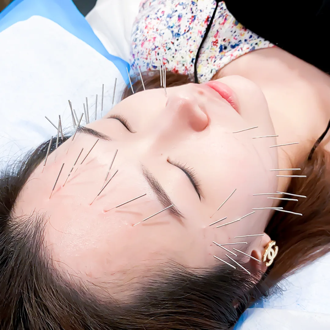Facial Acupuncture